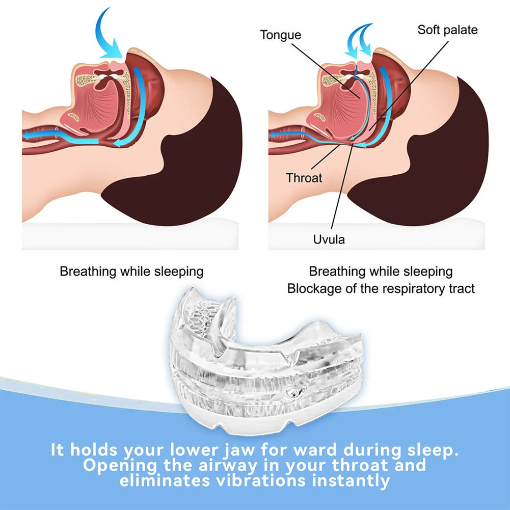 SnoRid™ AntiSnore Mouth Guard