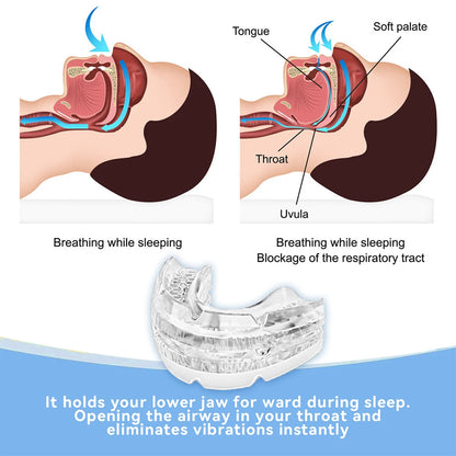 SnoRid™ AntiSnore Mouth Guard